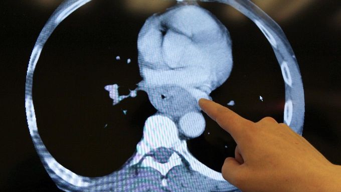 Rentgen průřezu hrudním košem ukazuje zúžený jícen pod vlivem bujení nádoru.
