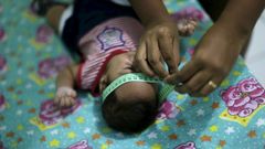 Guilherme Soares Amorim. Dvouměsíční dítě s mikrocefalií.