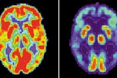 Krevní test odhalí Alzheimera tři roky předem