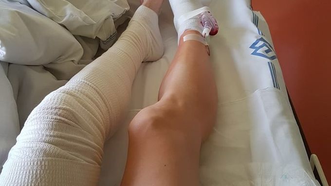 Nohy Denisy Rosolové po operaci