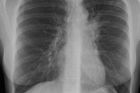 Tuberkulóza má do 40 let zmizet, leč v Česku jí přibývá