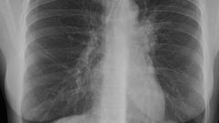 Plíce Tuberkulóza