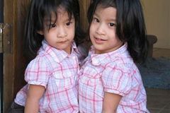 Američtí lékaři oddělili siamská dvojčata z Filipín