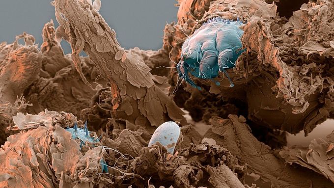 Zákožka svrabová - mikroskopický roztoč, který se živí lidskou kůží.
