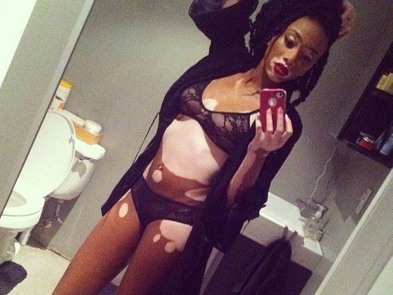 Vitiligo modelka Chantelle Brown-Young