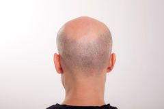 Objevili lékaři lék na plešatost? Růst vlasů podporují léky na autoimunitní onemocnění