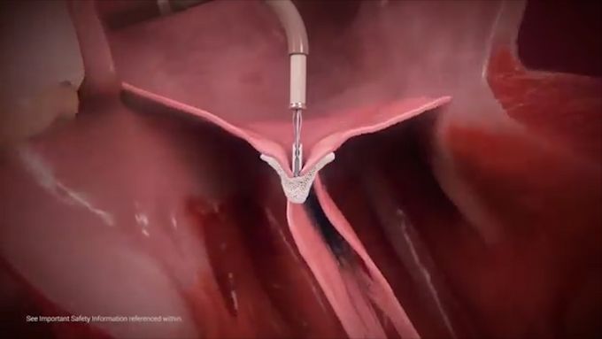 Podívejte se na počítačovou animaci, která ukazuje implantaci spony.