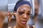 Exprostějovskou volejbalistku napadli v LA. Má poraněné oko