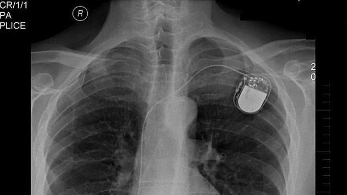 Kardiostimulátor na rentgenovém snímku.