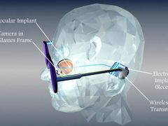 Kamera v brýlích snímá obraz před pacientem. Záběry se po zpracování přenesou do přijímače implantovaného do lebky za uchem a odtud se vedou po drátech k čipu v sítnici oka. Ten je přenese do zrakových nervů.