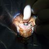Laserová operace šedého zákalu