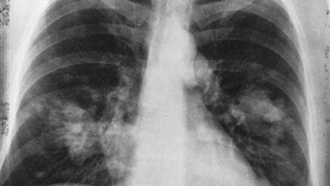 Rakovina plic na rentgenovém snímku. Ilustrační foto.