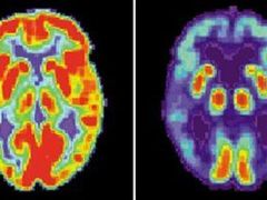 Snímek zobrazuje zdravý mozek (nalevo) a mozek napadený Alzheimerovou chorobou.