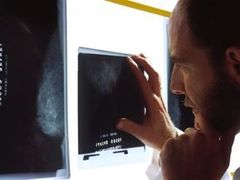 Mamografické vyšetření. Ženy mladší 45 let jsou po zjištění nádoru více ohroženy než starší pacientky.