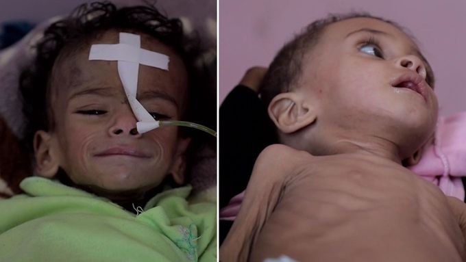 Hospitalizované jemenské děti.