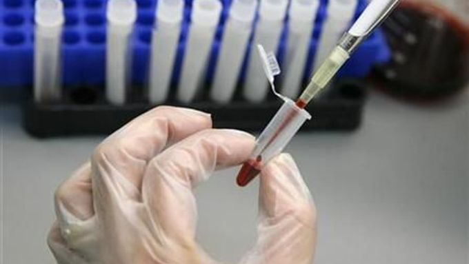 Laboratorní technik připravuje vzorek krve na test HIV. Ilustrační snímek