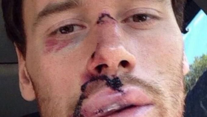 Sešitý obličej Martina Havláta. Český hokejista se ošklivě zranil ve Washingtonu, když neštastně vrazil do loktu rozhodčího. Podívejte se, jak vypadá.