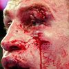 Hrozivá zranění v boxerské historii (Vitalij Kličko)
