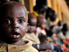 Podvyživené dítě v nemocnici ve městě Matany na severovýchodě Ugandy