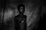 Heba Khamisová (Egypt): Zakázaná krása. Ženy v Kamerunu žehlí horkými předměty prsa děvčat ve věku od 8 do 12 let. Věří, že pak neporostou a dívky tak budou uchráněny před zneužitím a znásilněním.