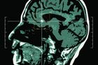 Mozek, mozkový nádor, ilustrační foto