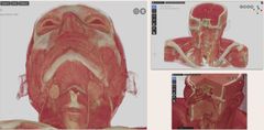 Dobře viditelný model mezi „mračnem bodů“ které vznikne při zpracování CT snímků (vlevo) a přehledným finálním 3D modelem (vpravo).