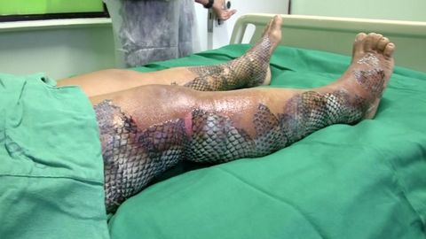 Nová léčba těžkých popálenin. Brazilci kladou na zranění rybí kůži