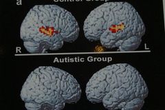 Jak léčit autismus? V dekompresní komoře