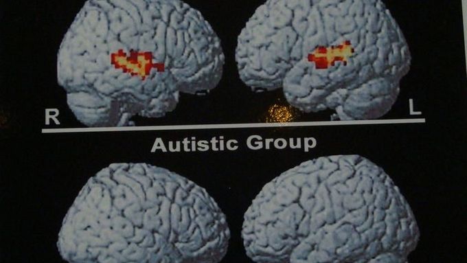 Obraz běžného mozku (nahoře) a mozku dítěte trpícího autismem (poruchou kontaktu s okolním světem) při reakci na lidský hlas.