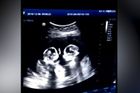 Boj o místo v děloze. “Hovory” vzácných dvojčat odhalil ultrazvuk