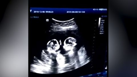 Boj o místo v děloze. “Hovory” vzácných dvojčat odhalil ultrazvuk