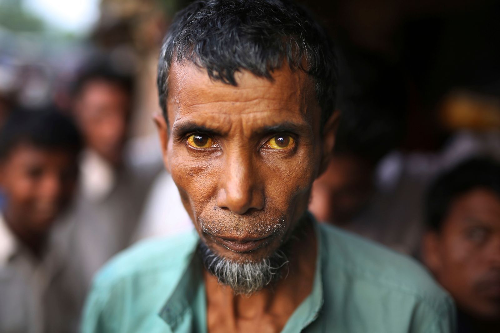 Rohingský uprchlík v bangladéšském táboře Kutupalong, který trpí žloutenkou.
