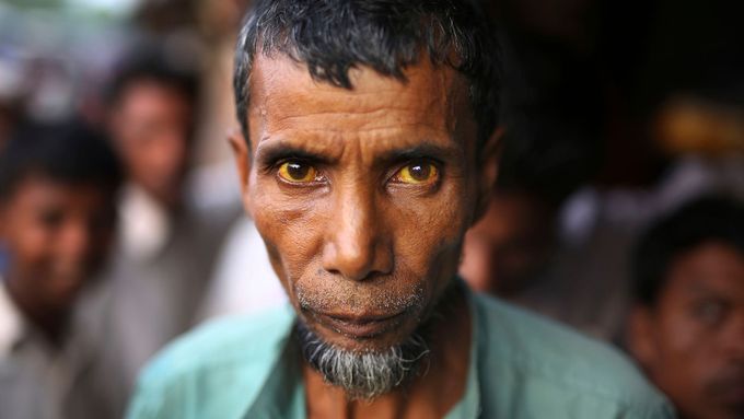 Rohingský uprchlík v bangladéšském táboře Kutupalong, který trpí žloutenkou.