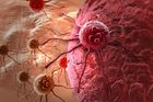 Půl milionu lidí s rakovinou? Bude hůř, nemocní v Česku přibývají, říká onkoložka