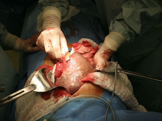 Jak probíhá transplantace Transplantace jater