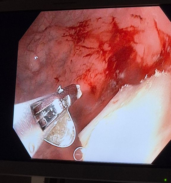 Díky rychlé lékařské intervenci se ve všech případech podařilo předejít nutnosti chirurgického výkonu.