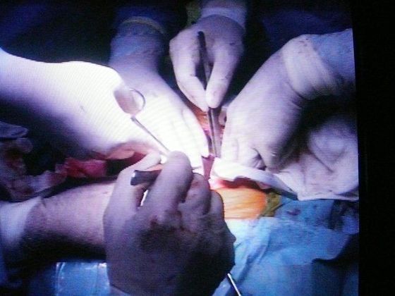 Případ siamských dvojčat Operace siamských dvojčat