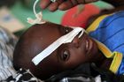V Somálsku prudce přibývá případů dětské obrny