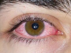 Záněty očí se mohou projevit zarudnutím, pálením, svěděním nebo pocitem cizího tělíska v oku. Často je doprovází i větší potřeba mrkat nebo slzení.