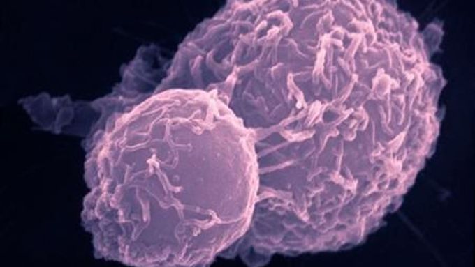 Mikrosnímek rakovinných buněk v tlustém střevě. Menší z buněk je ještě nevyvinutá.