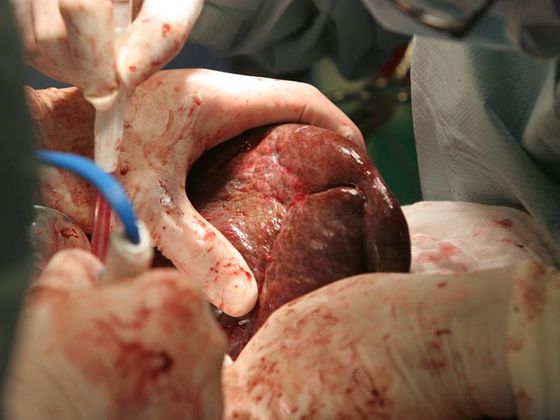 Čtěte více o darování orgánů Transplantace jater
