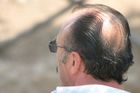 Konec plešatění? Vědci vědí, jak obnovit růst vlasů