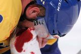 Zkrvavený Johan Franzén si přikládá ručník ke zlomenému nosu