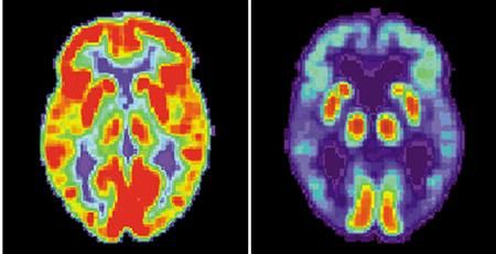 Snímek zobrazuje zdravý mozek (nalevo) a mozek napadený Alzheimerovou chorobou. | Foto: Reuters