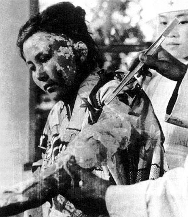 Dvaadvacetiletá Tojoko Kugataová při ošetření popálenin, které utrpěla po výbuchu atomové bomby v Hirošimě. | Foto: Public Domain