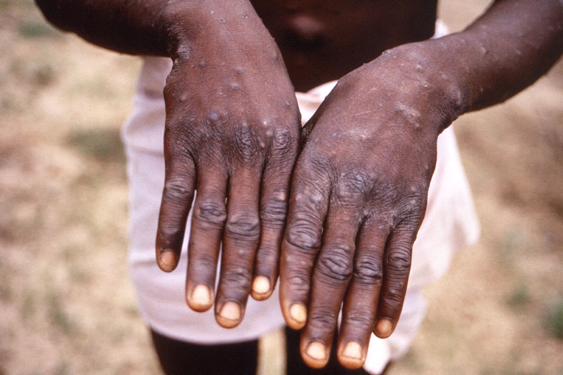 The first case of monkeypox appeared in the Czech Republic, the patient was in a Prague hospital