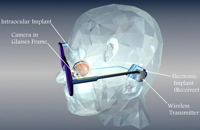 Kamera v brýlích snímá obraz před pacientem. Záběry se po zpracování přenesou do přijímače implantovaného do lebky za uchem a odtud se vedou po drátech k čipu v sítnici oka. Ten je přenese do zrakových nervů. | Foto: University of Southern California