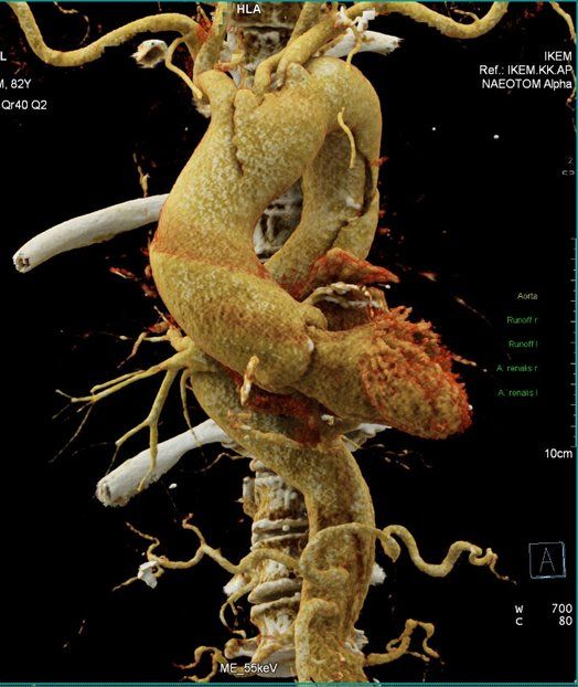 CT angiografie, rozštěpení stěny srdečnice. | Foto: IKEM