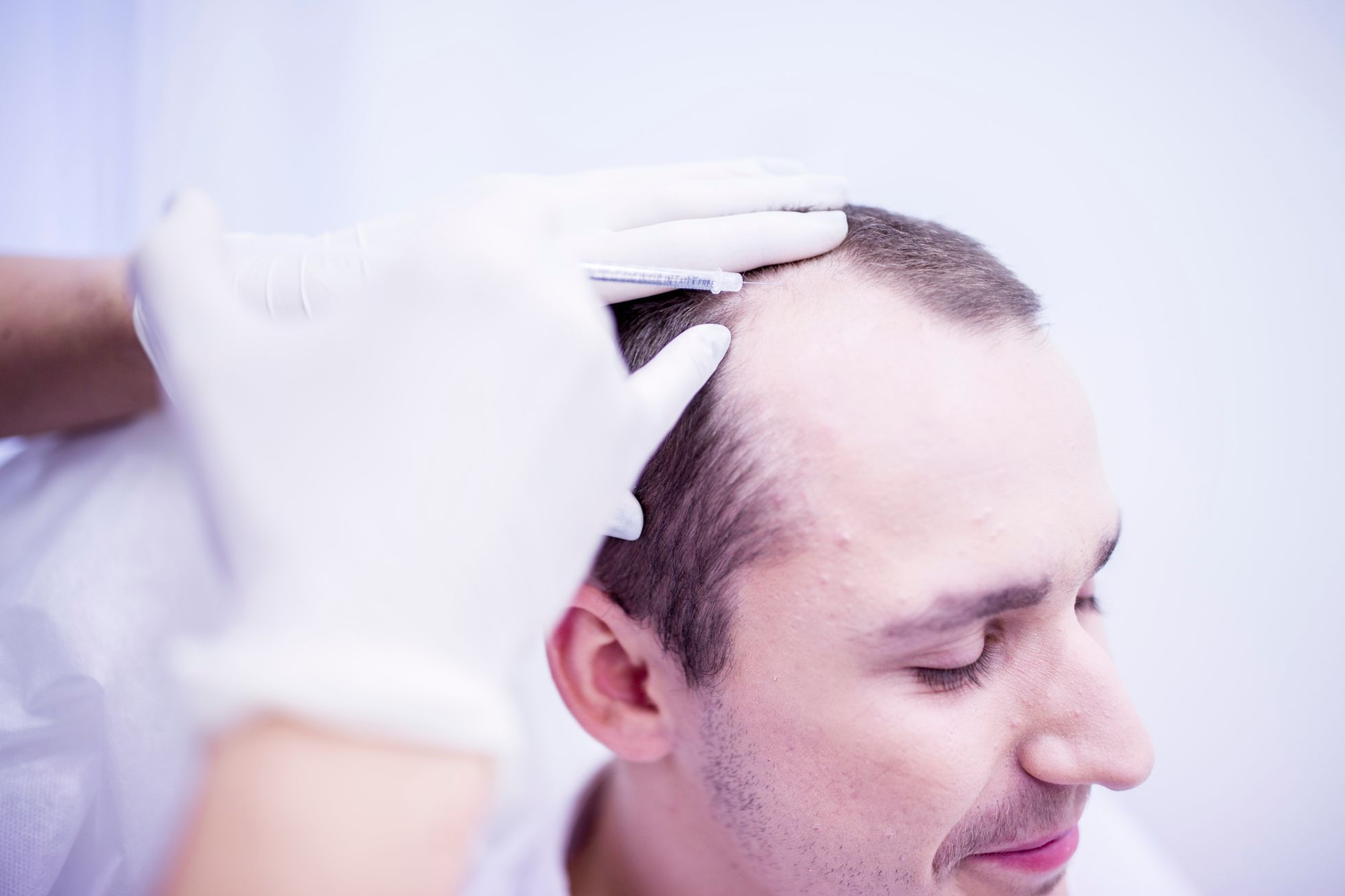 Мезотерапия волос мужчин. Мезотерапия волосистой части головы. Стрижки при облысении.