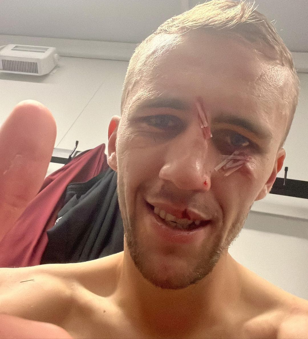 Stitches on the face and nose and also a sewn-on lip.  Souček is ready for the European League